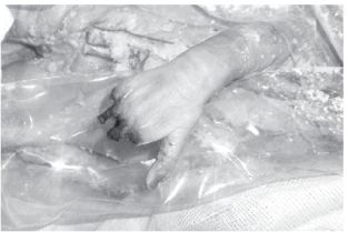 The Child could have lived a few more days | In MY, the girl could live for a few more days: Doctor said – not a dog, three fingers were eaten by rats, infection also happened – Indore News
